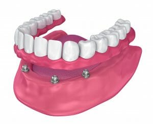 Implant Supported Dentures