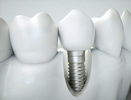 Dental Implant