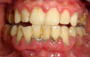 Periodontal Disease